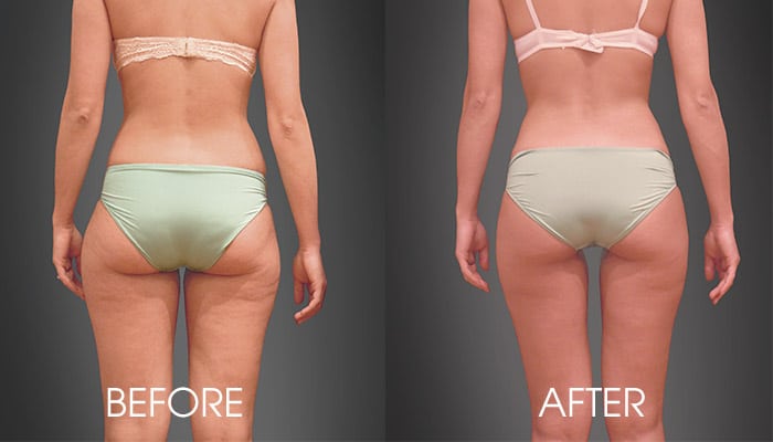 https://hypoxibulimba.com.au/wp-content/uploads/2022/07/HYPOXI-before-after.jpg